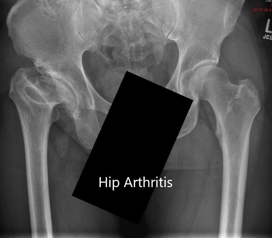 Hip Xray 6 Hip Xray 6