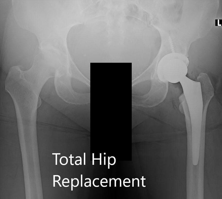 Hip Xray 7 Hip Xray 7