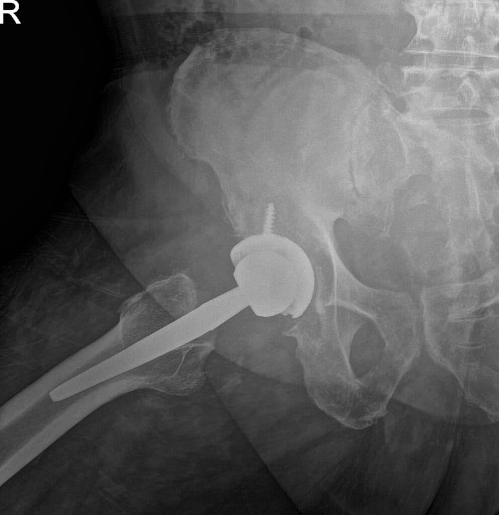 Hip Xray Hip Xray