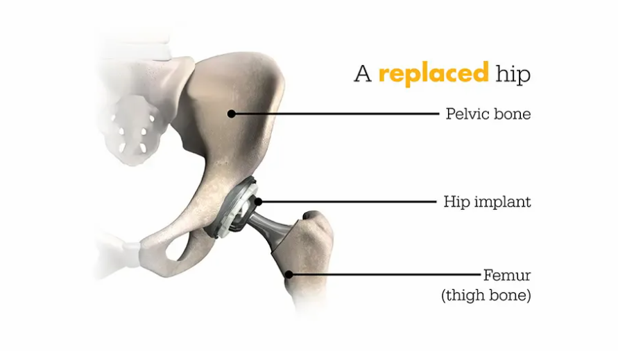 Replaced Hip image