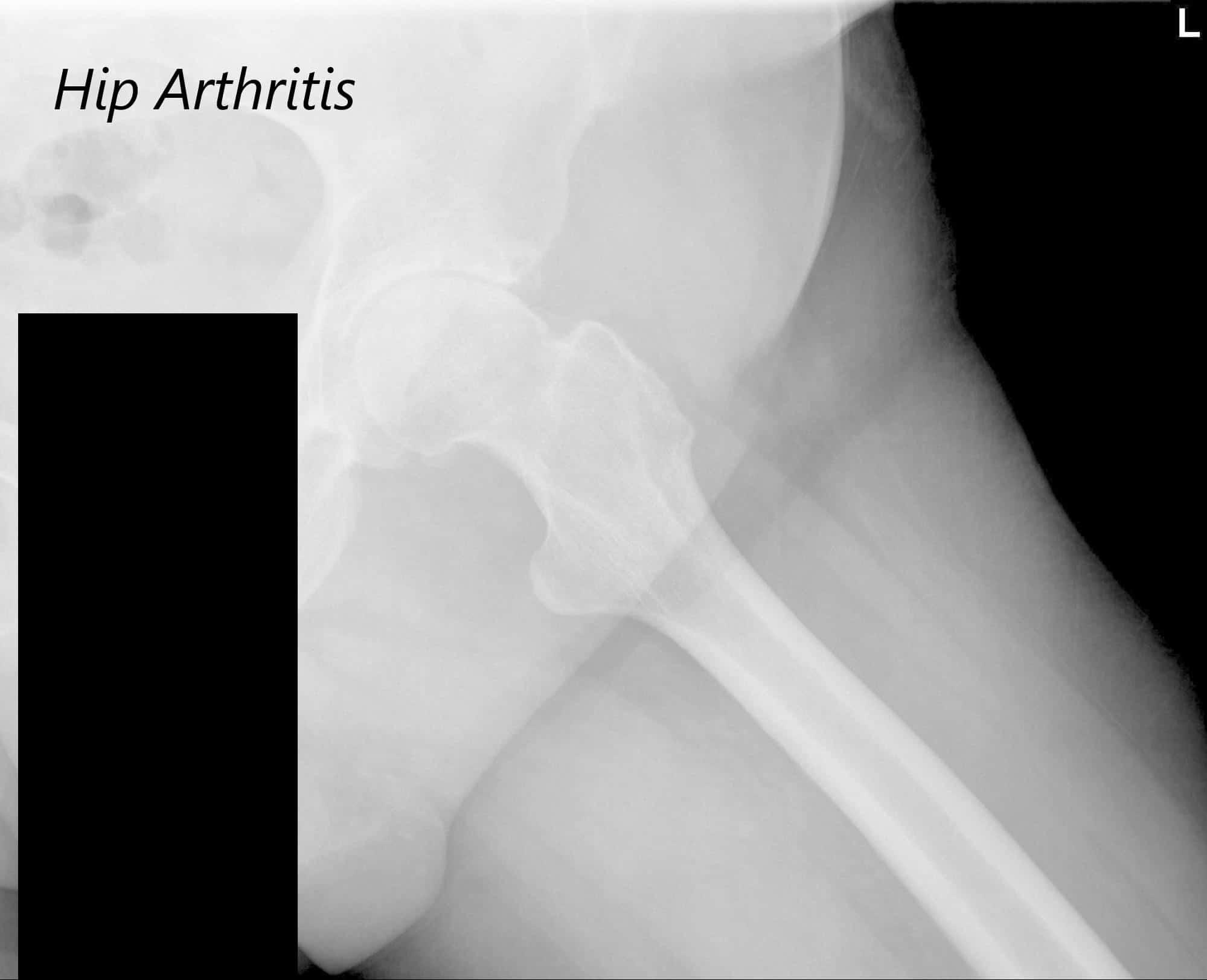 Anteroposterior view of the Pelvis X ray Anteroposterior view of the Pelvis X ray