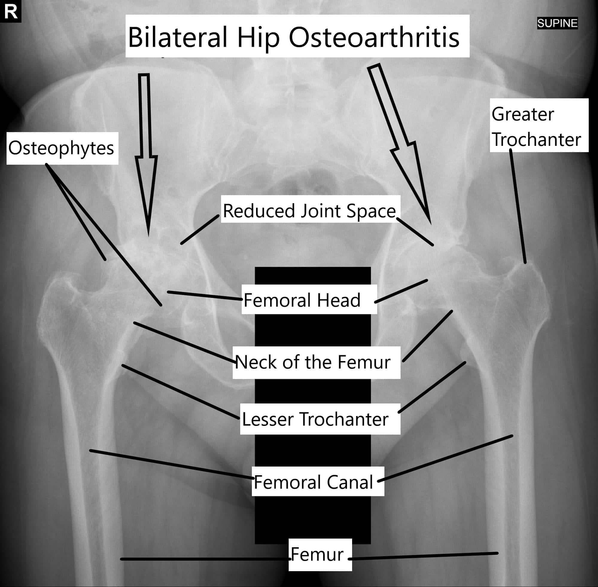 Bilateral Hip arthritis Bilateral Hip arthritis