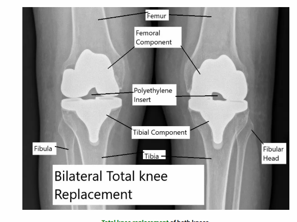 Bilateral Total Knee Replacement