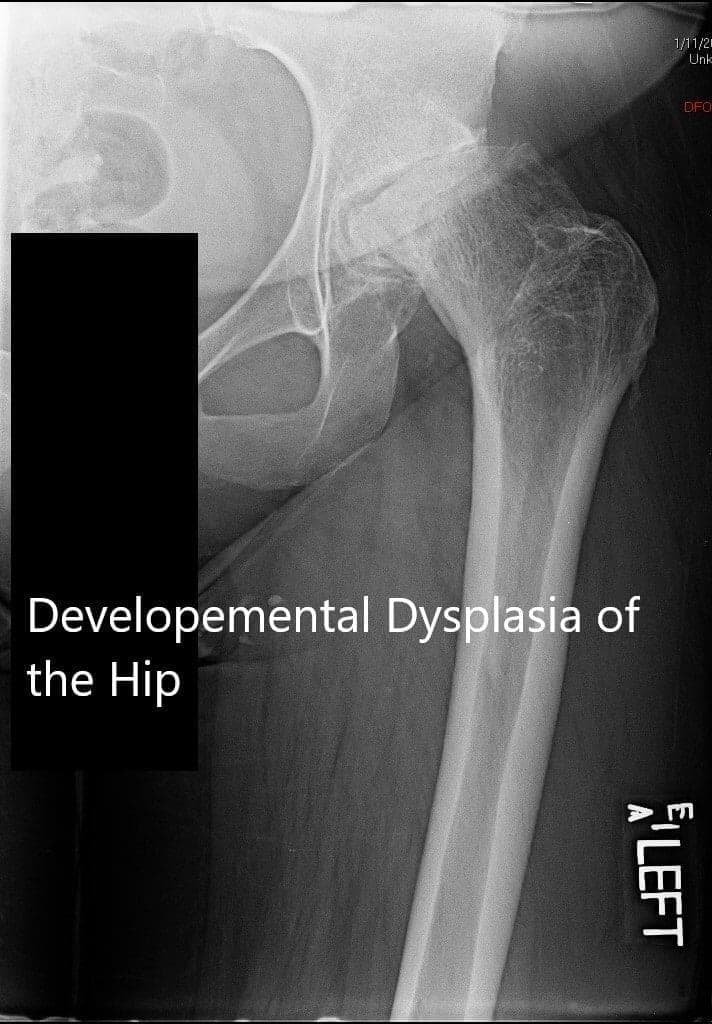Developmental Dysplasia of the Hip Developmental Dysplasia of the Hip