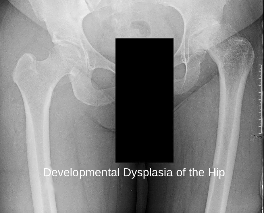 Developmental Dysplasia of the Hip Preoperative X-ray showing an anteroposterior view of the pelvis with both hip joints, in a 48-year-old man with the long-term consequences of developmental dysplasia of the hip. A socket shaped like this is exactly the situation in which I do want a measurement. Documented on this site as Robotic Total Hip Replacement in a 48-year-old male with sequel of Developmental Dysplasia of the Hip.