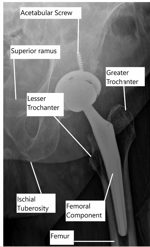 Hip Replacement 1 Hip Replacement 1
