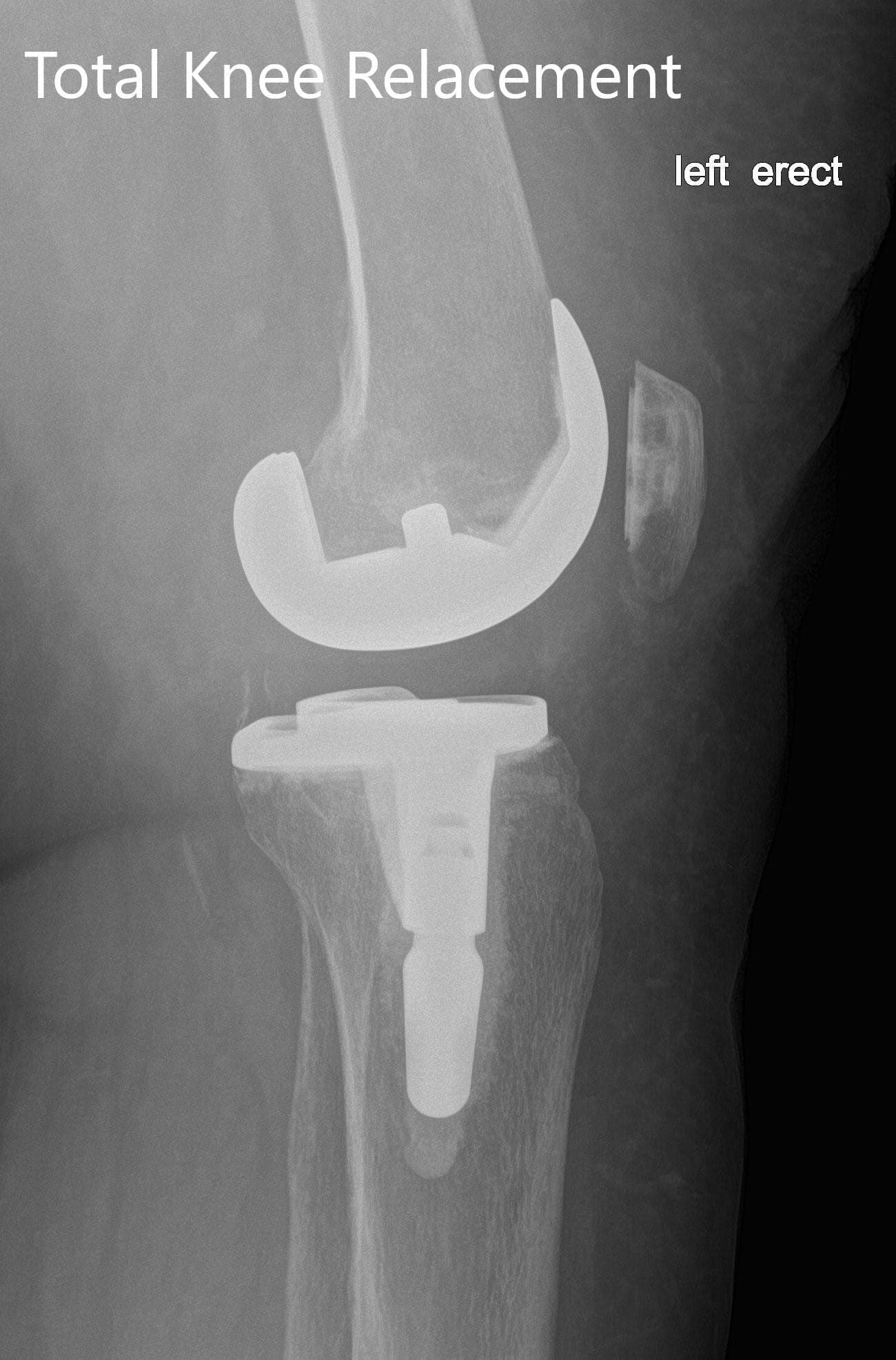 Left showing the anteroposterior and lateral view Left showing the anteroposterior and lateral view