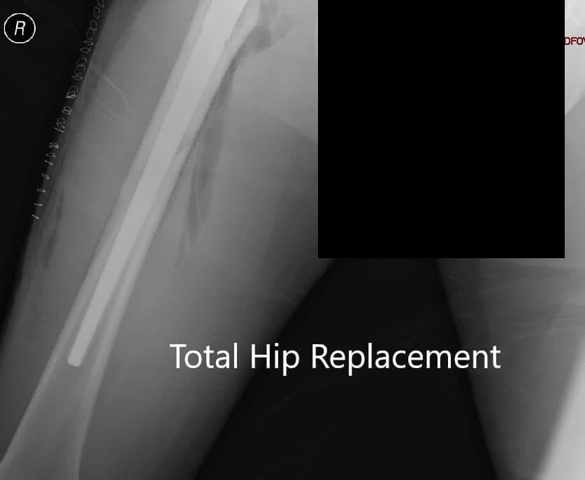 Post-operative X-ray 1 Post-operative X-ray 1