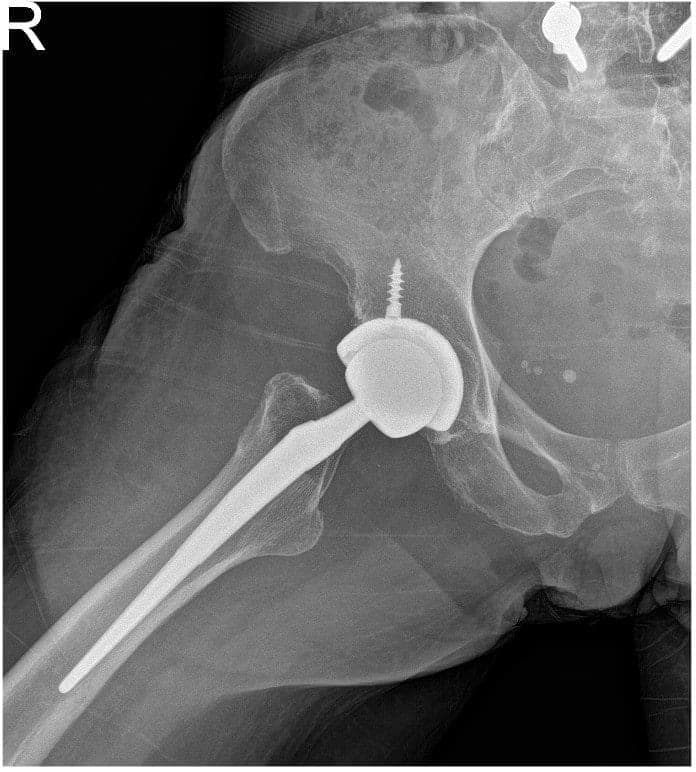 Post-operative X-ray 2 Post-operative X-ray 2