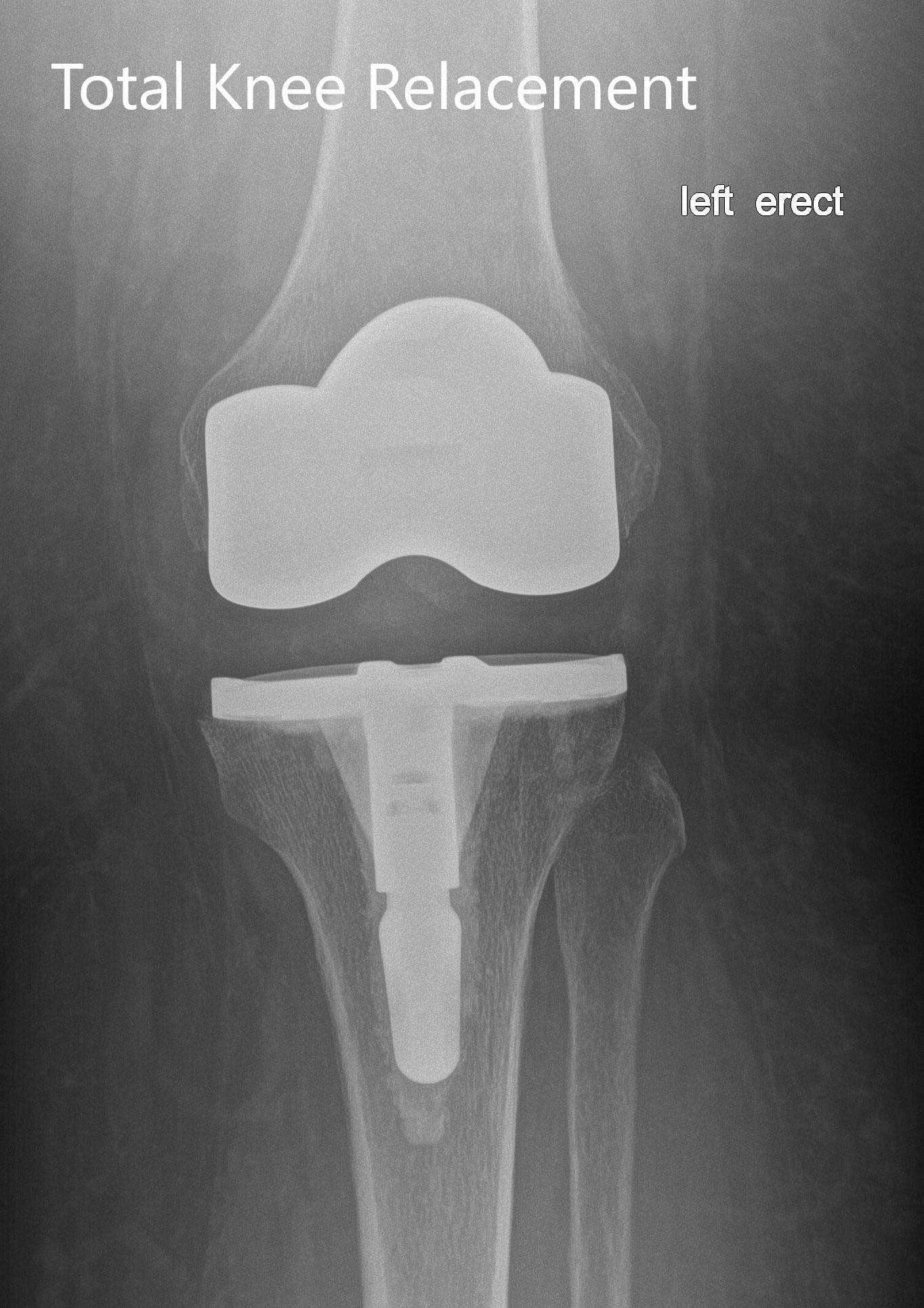 Postoperative X-ray of the left Postoperative X-ray of the left