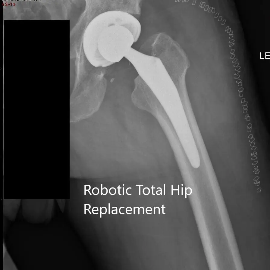 Postoperative x-ray of the left hip showing the shell Postoperative x-ray of the left hip showing the shell