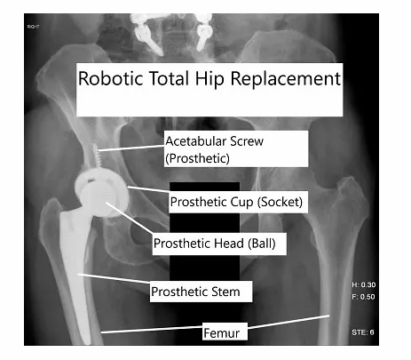 Postoperative x-ray of the pelvis after a right hip replacement Postoperative x-ray of the pelvis after a right hip replacement