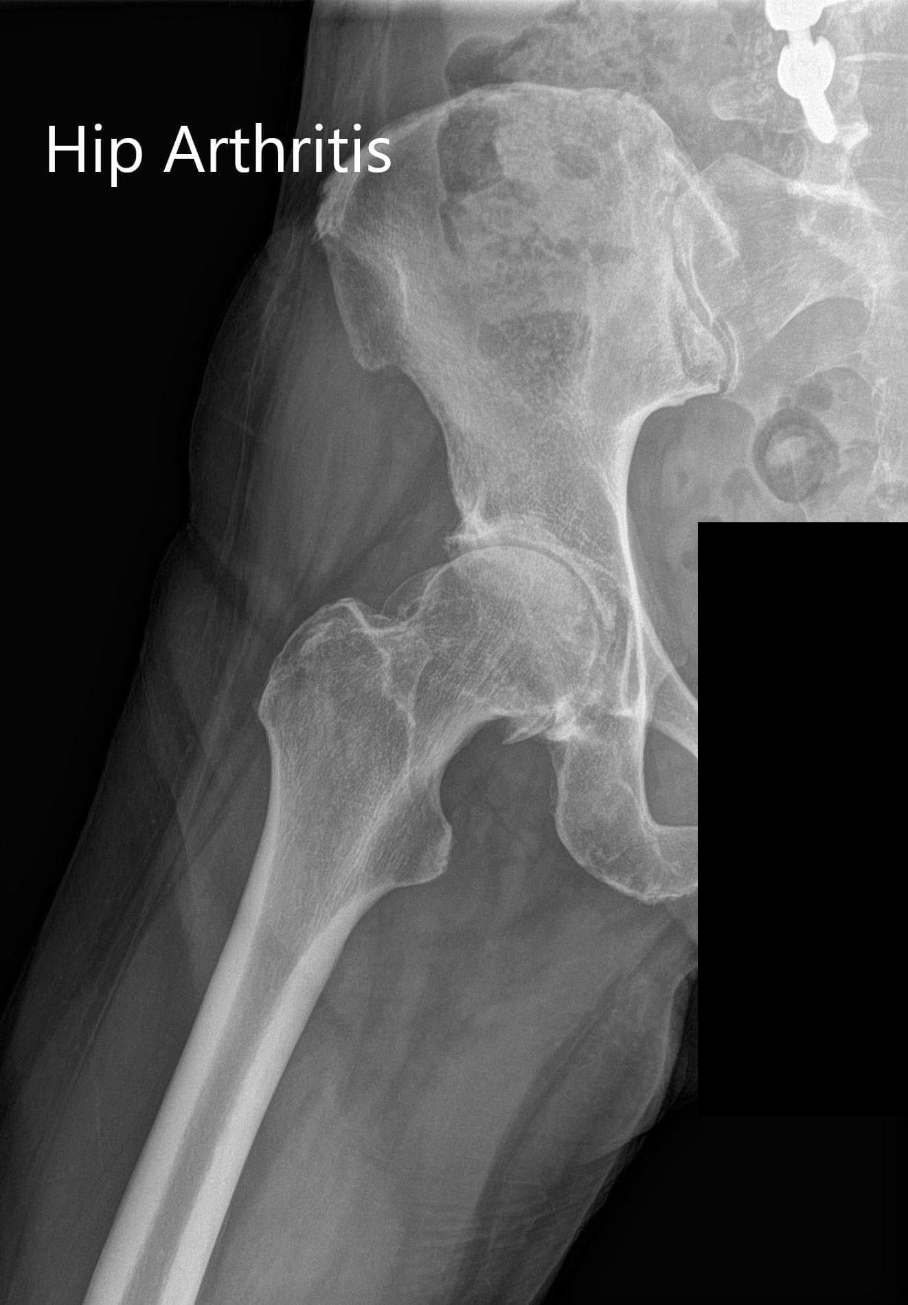 Preoperative X-ray 1 Preoperative X-ray 1