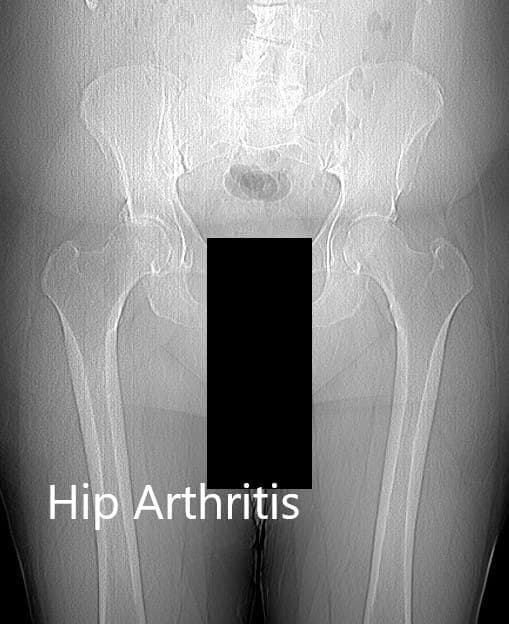 Preoperative X-ray 3 Preoperative X-ray showing an anteroposterior view of the pelvis with both hip joints, in a 65-year-old woman with arthritis affecting both sides. Documented on this site as Robotic Bilateral Total Hip Replacement in a 65-year-old female with Arthritis.