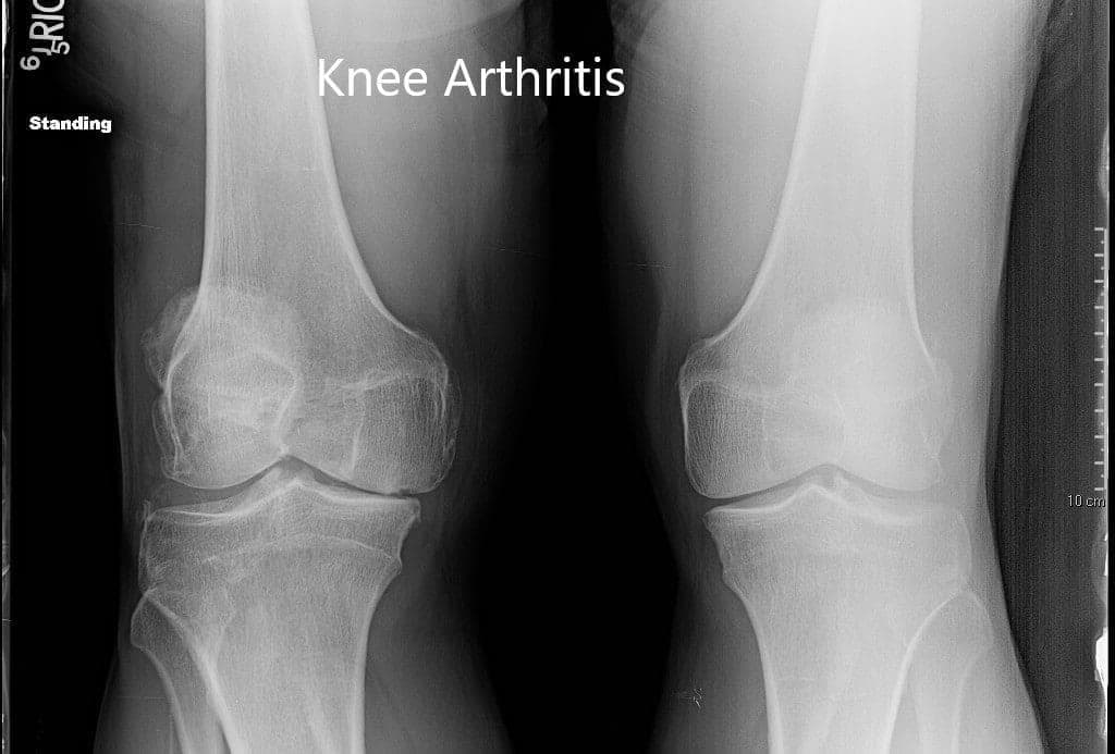 Preoperative X-ray of both the knees Preoperative X-ray of both the knees