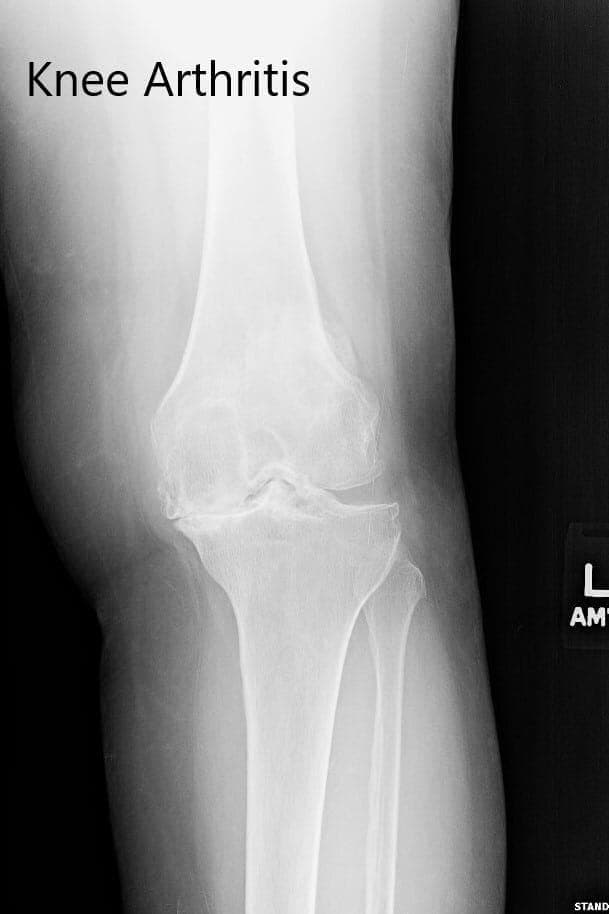 Preoperative X-ray of the left knee Preoperative X-ray of the left knee