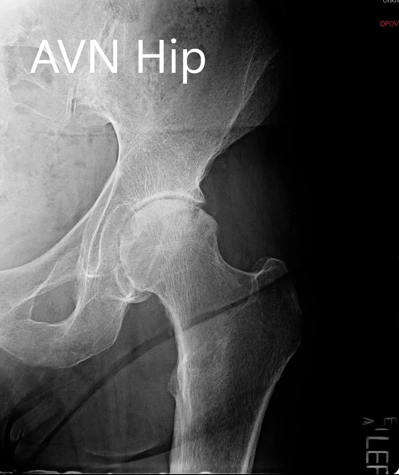 Preoperative x-ray of the left hip Preoperative x-ray of the left hip