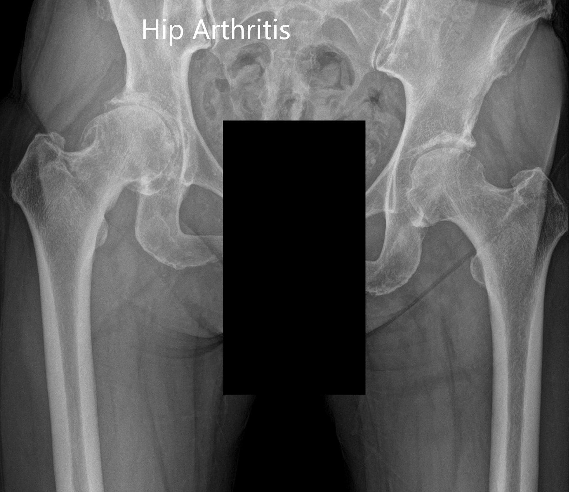 Preoperative x-ray of the pelvis showing an anteroposterior view 2 Preoperative x-ray of the pelvis showing an anteroposterior view 2