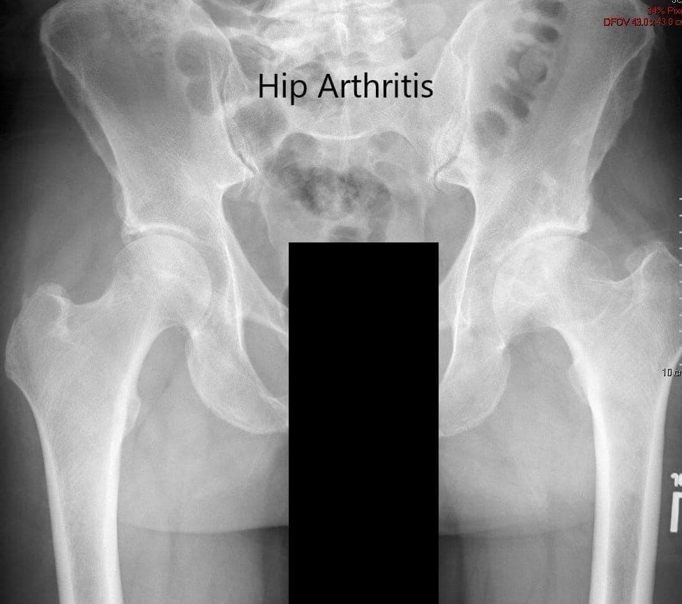 Preoperative x-ray of the pelvis showing an anteroposterior view Preoperative x-ray of the pelvis showing an anteroposterior view