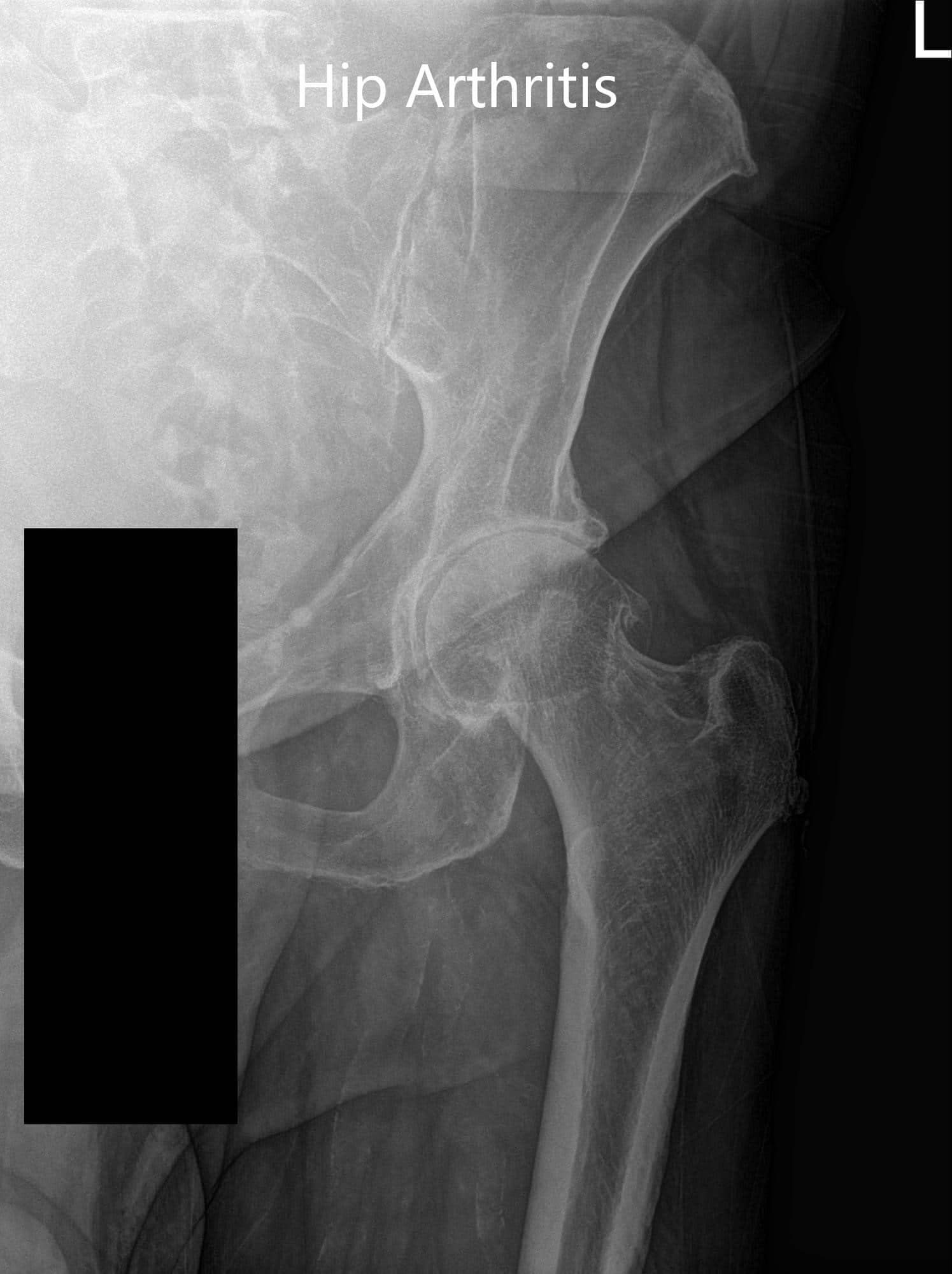 Preoperative x-ray showing an anteroposterior view of the left hip Preoperative x-ray showing an anteroposterior view of the left hip