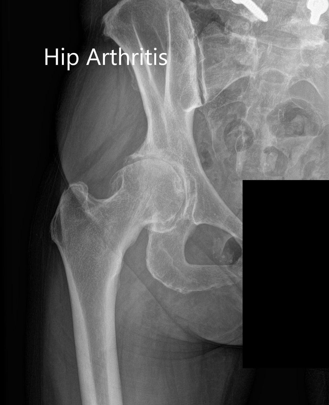 Right Hip Arthritis Right Hip Arthritis