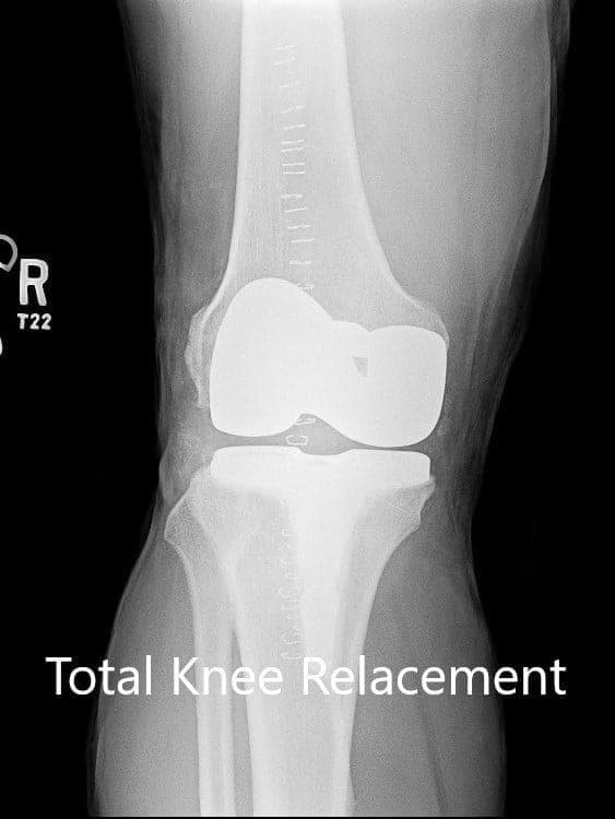 Right knee with a prosthesis in anteroposterior and lateral views 2 Right knee with a prosthesis in anteroposterior and lateral views 2
