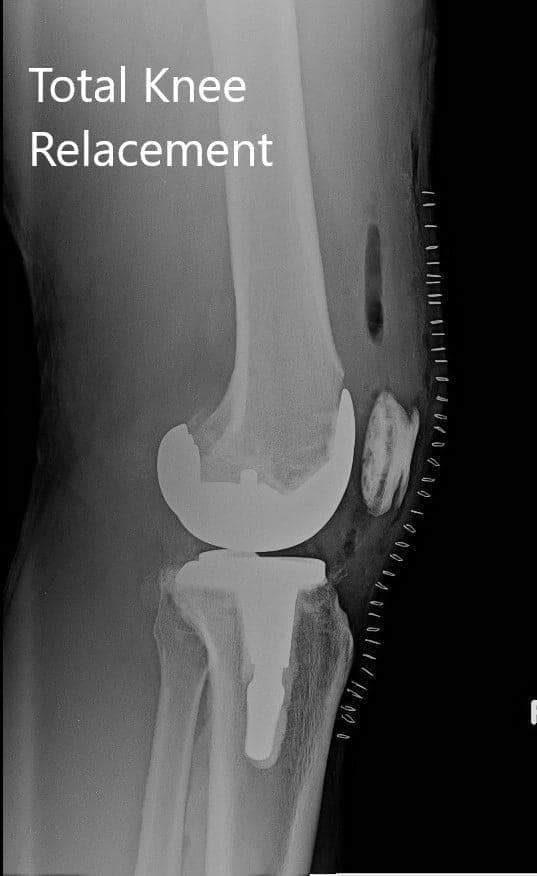 Right knee with a prosthesis in anteroposterior and lateral views Right knee with a prosthesis in anteroposterior and lateral views