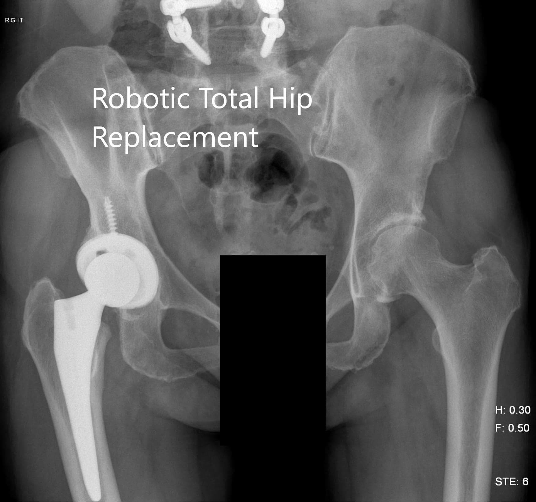 Robotic Total Hip Replacement Robotic Total Hip Replacement