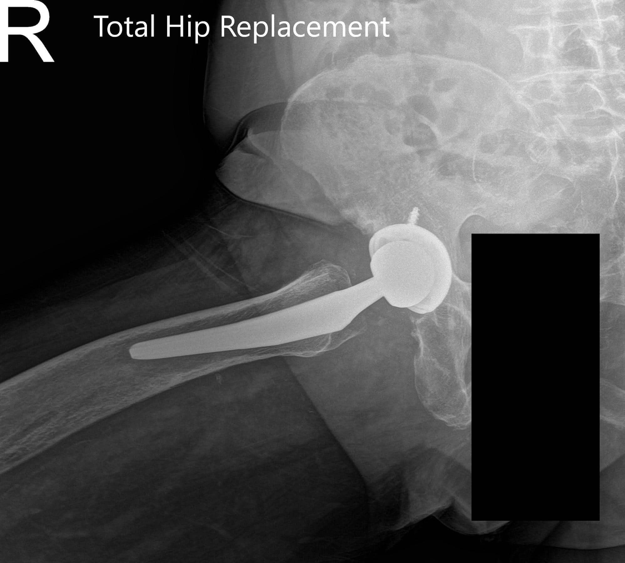 Total Hip Replacement 2 Total Hip Replacement 2