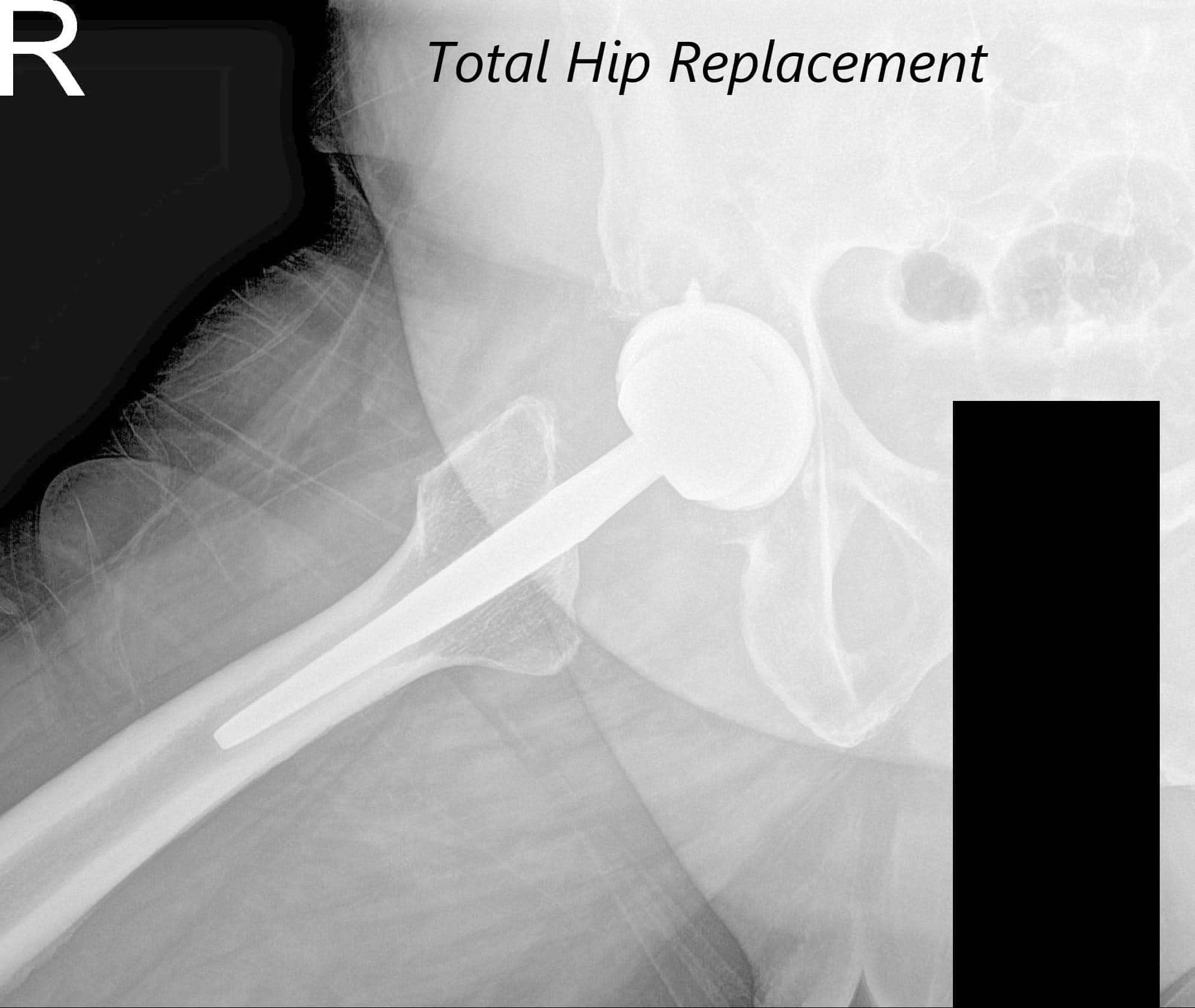 Total Hip Replacement 3 Total Hip Replacement 3