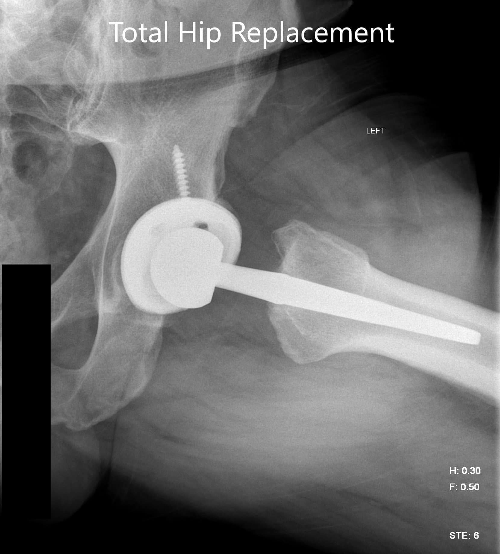 Total Hip Replacement 4 Total Hip Replacement 4