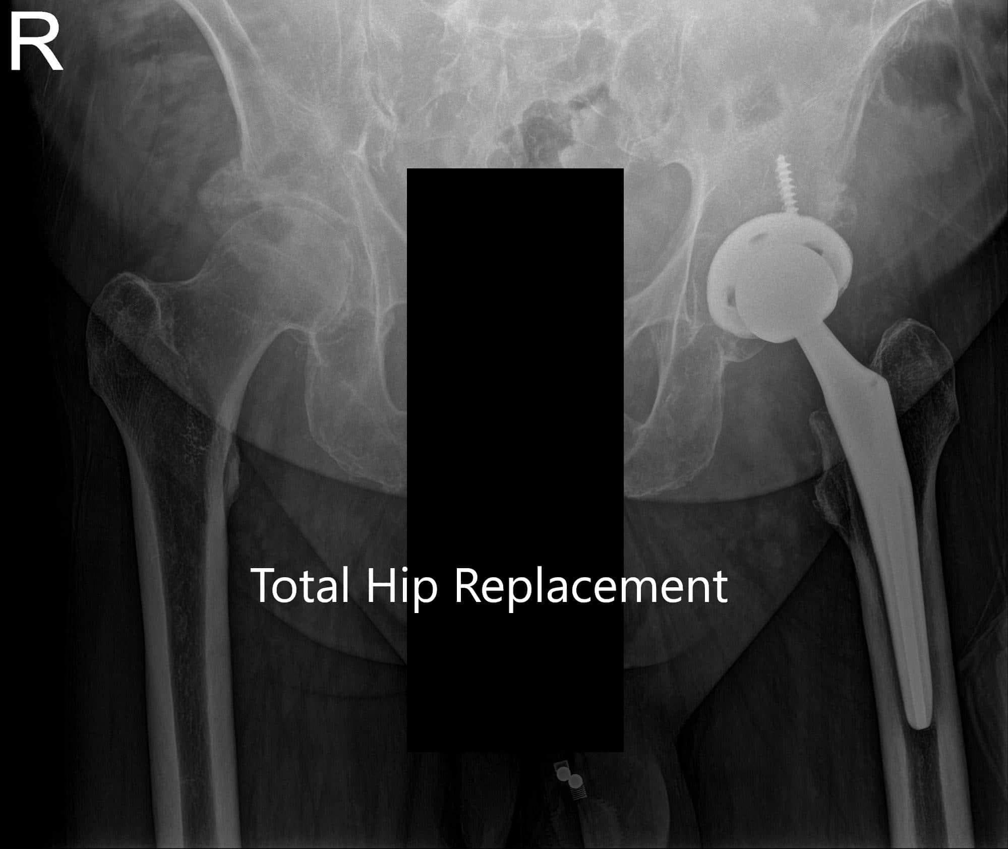 Total Hip Replacement 1 Total Hip Replacement 1
