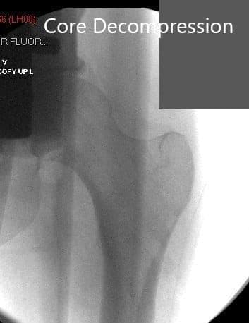 Total Hip Replacement
