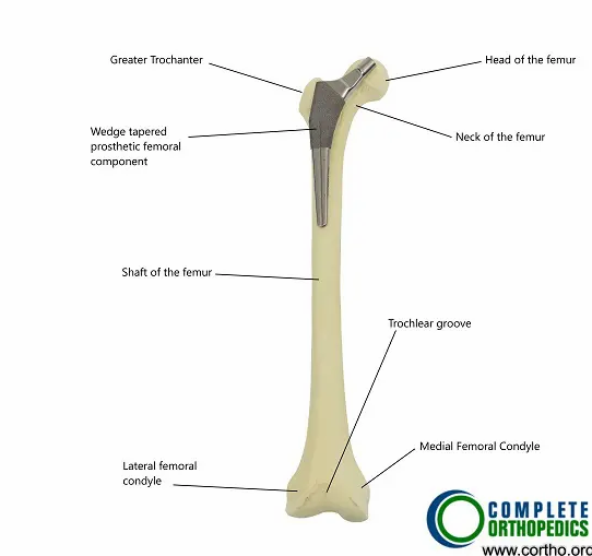 Total Hip Replacement Total Hip Replacement