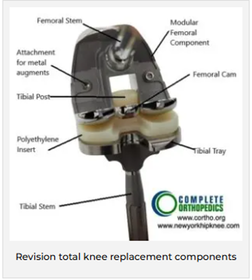 Total Knee Replacement Components 3 Total Knee Replacement Components 3