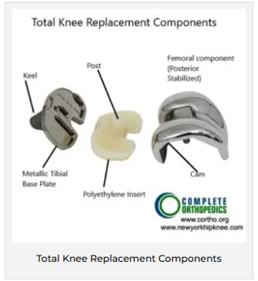 Total Knee Replacement Components Total Knee Replacement Components