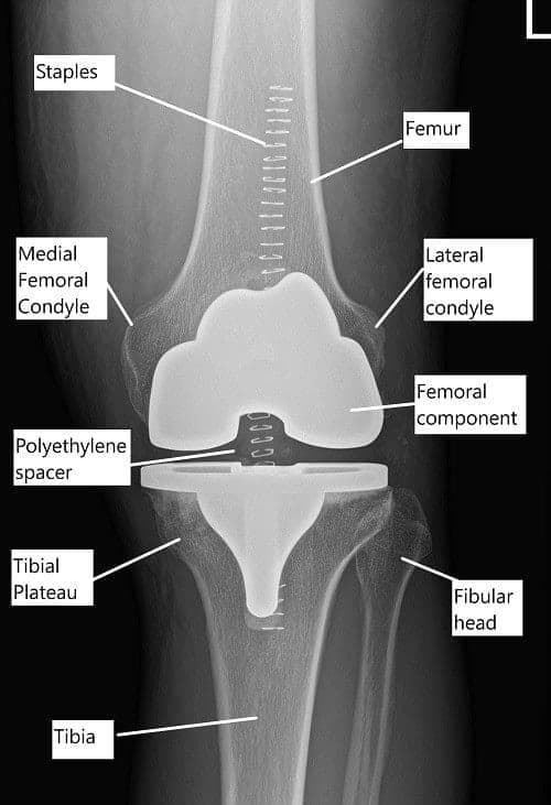 Total knee replacement Post-op X-ray Total knee replacement Post-op X-ray