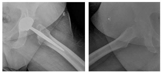 Hip-Xray2