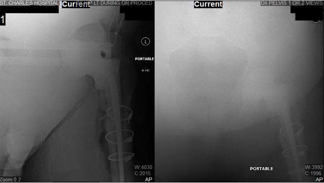 Hip-Xray3 Hip-Xray3