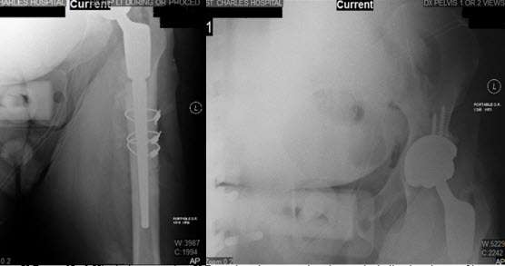 Hip-Xray4 Hip-Xray4