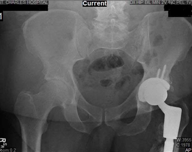 Hip-Xray5 Hip-Xray5