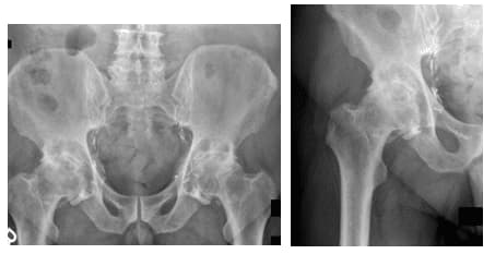 Hip Arthritis 1 Hip Arthritis 1