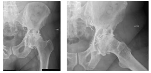 Hip Arthritis 3 Hip Arthritis 3