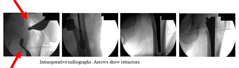 Native Hip with Arthritis 2 Native Hip with Arthritis 2