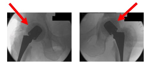Native Hip with Arthritis 3 Native Hip with Arthritis 3