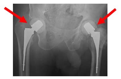Native Hip with Arthritis 4 Native Hip with Arthritis 4