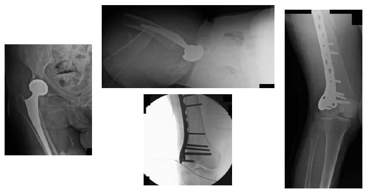 Fracture périprothétique 1 Fracture périprothétique 1