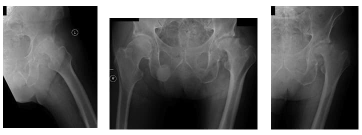 Total Hip Arthroplasty 1