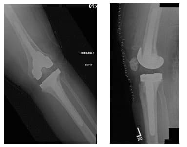 Total Knee Replacement 3 Total Knee Replacement 3