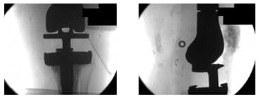 Tumor Prosthesis 2